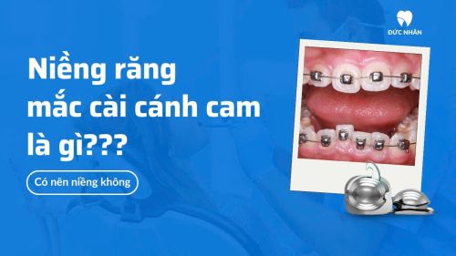 Niềng răng mắc cài cánh cam là gì? Có nên niềng không?
